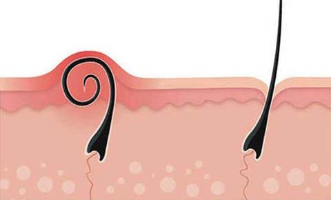 beard ingrown hair ingrown hair