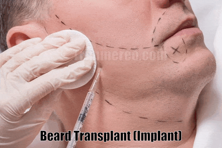 beard transplant implant