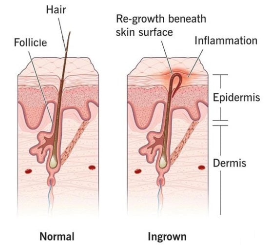 Ingrown Hairs
