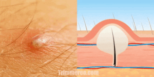 Ingrown Hair