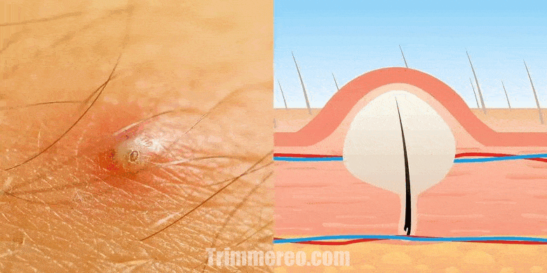 Ingrown Hair