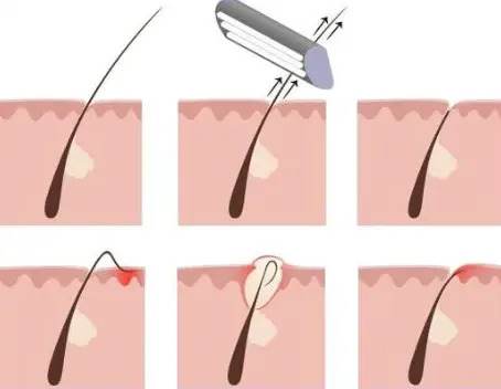 razor bumps